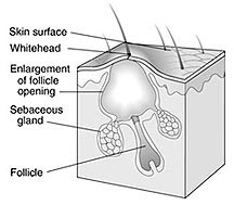 Closed Comedone (White Head) 